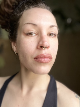 filter foundation botox fillers